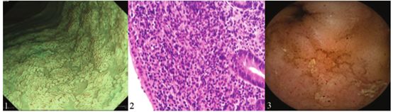 腹痛水样便打嗝有臭味吃什么药,腹痛呕清水是怎么回事