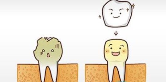 根管治疗加牙套多少钱,根管治疗后还要做牙套吗