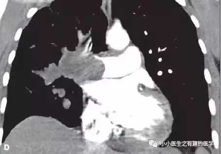 肺动脉分支充盈欠佳是肺栓塞吗,肺动脉缺损不可逆