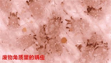 脸上搓下来很多泥,脸上搓出黑头