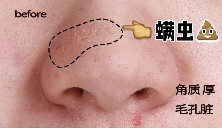 柔嫩抛光|脸上搓出3斤泥！难怪又黄又暗又黑头！10秒给脸蛋“剥壳”，厉害