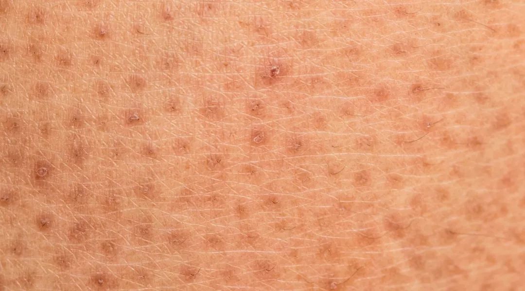 冬天皮肤起皮干燥有碎屑怎么保湿,下巴周围干燥起皮有小疙瘩