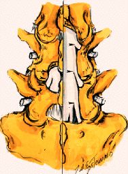 一分钟带你了解腰椎狭窄,椎管狭窄症知识大全