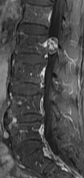 一分钟带你了解腰椎狭窄,椎管狭窄症知识大全