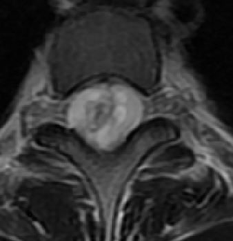 一分钟带你了解腰椎狭窄,椎管狭窄症知识大全