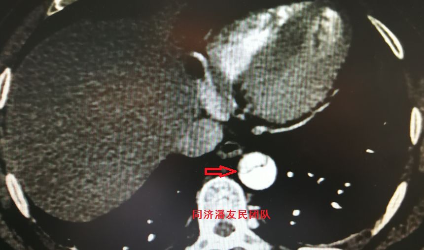 主动脉夹层如何快速确诊,确诊主动脉夹层最可靠办法