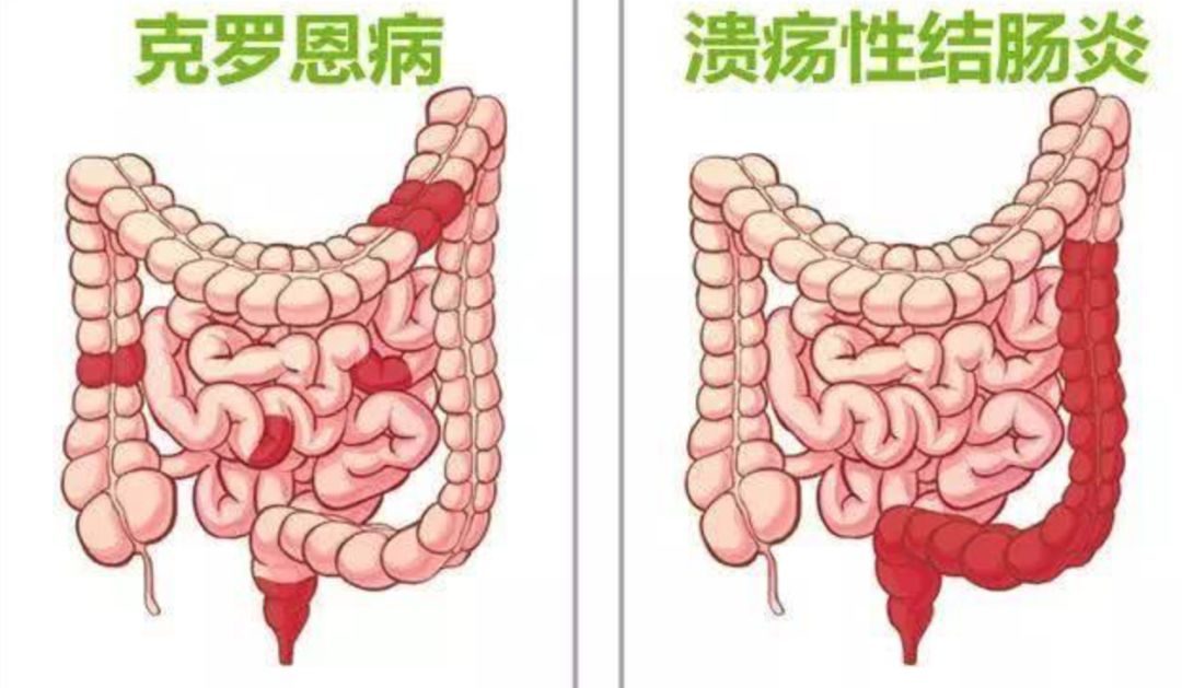 不是癌症的恶性肿瘤有哪些,不是癌症的绝症有哪些