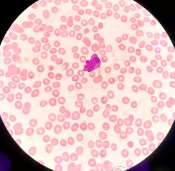 外周血细胞形态分析能查出什么病,外周血细胞形态能看出白血病吗