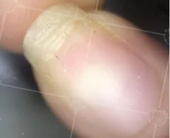 灰指甲美甲处理,灰指甲霉菌感染致癌