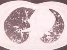 igg4相关性疾病中医辨证论治,igg4相关性眼病最新研究成果