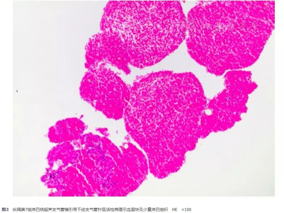 胸腺鳞癌临床出现的几率是多少,胸腺鳞癌一期高分化能活十年吗