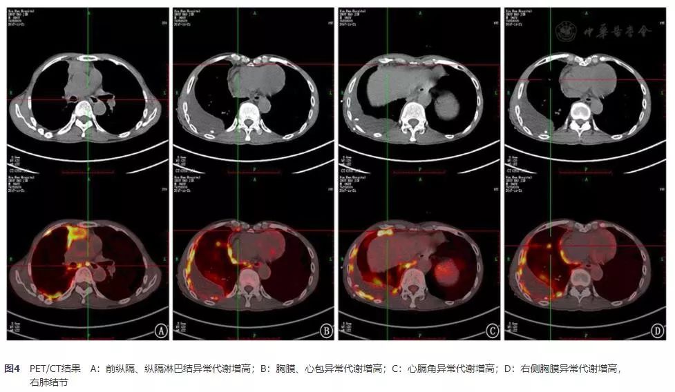 胸腺鳞癌临床出现的几率是多少,胸腺鳞癌一期高分化能活十年吗