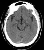 Reco特约·第10期｜国产组合助力取栓“一把通”——Ewata球囊导引导管联合Reco支架取栓分享