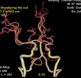 Reco特约·第10期｜国产组合助力取栓“一把通”——Ewata球囊导引导管联合Reco支架取栓分享
