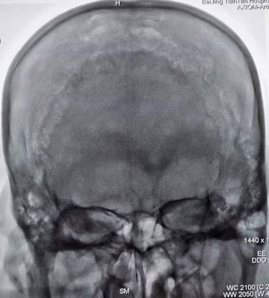 Reco特约·第10期｜国产组合助力取栓“一把通”——Ewata球囊导引导管联合Reco支架取栓分享