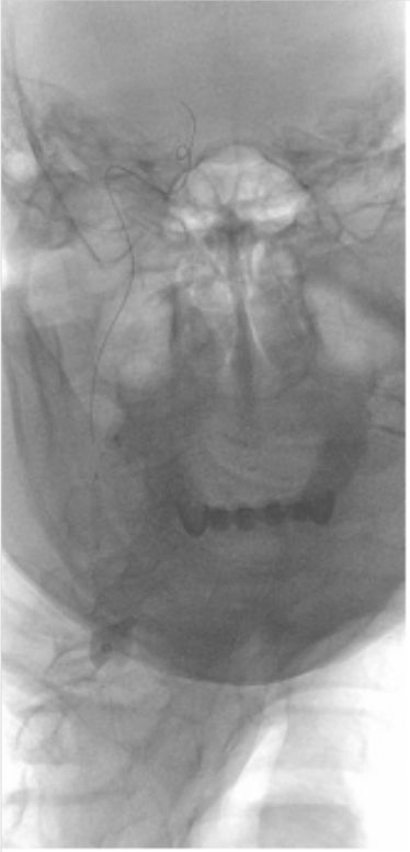 颈内动脉闭塞先进治疗,颈内动脉闭塞开通术病例讨论