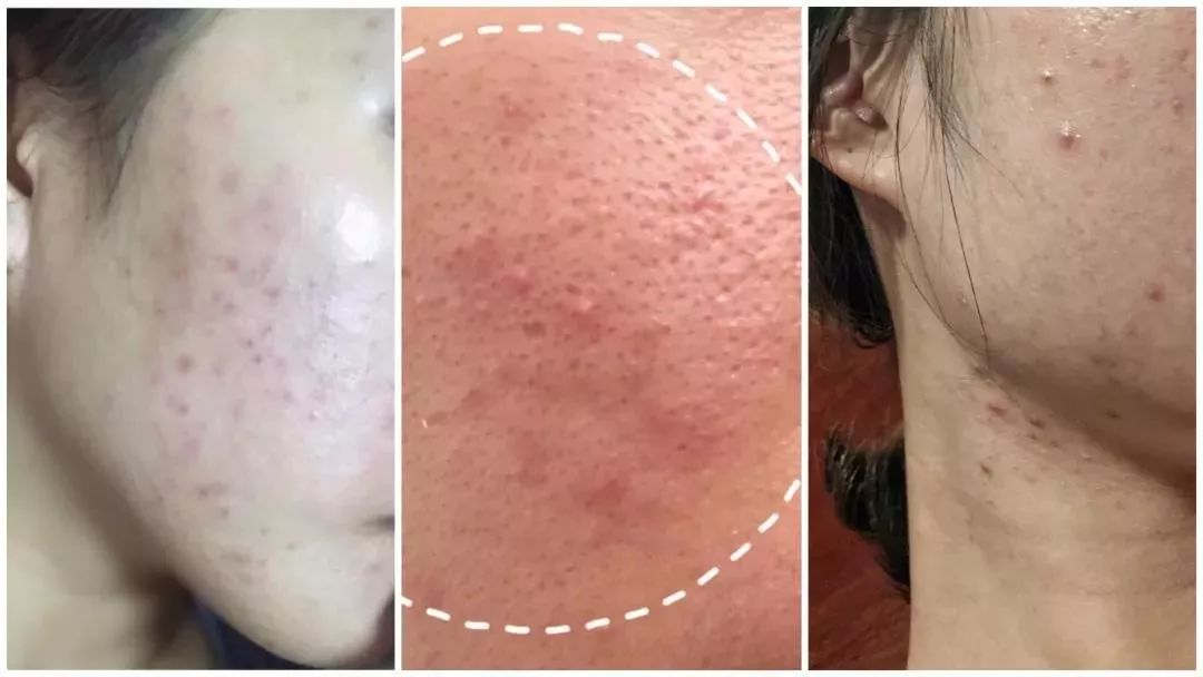 1分钱祛痘神器,祛痘神器0元领取