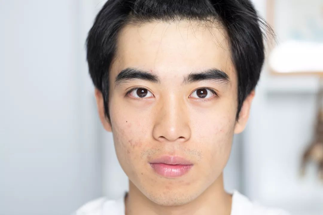 男士清理螨虫和黑头机器,男生青春痘黑头清洁神器