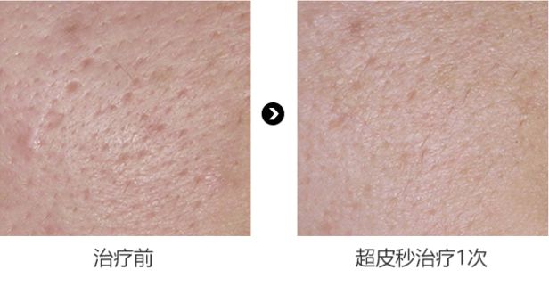 ‘斑’弄是非，超皮秒要你好看