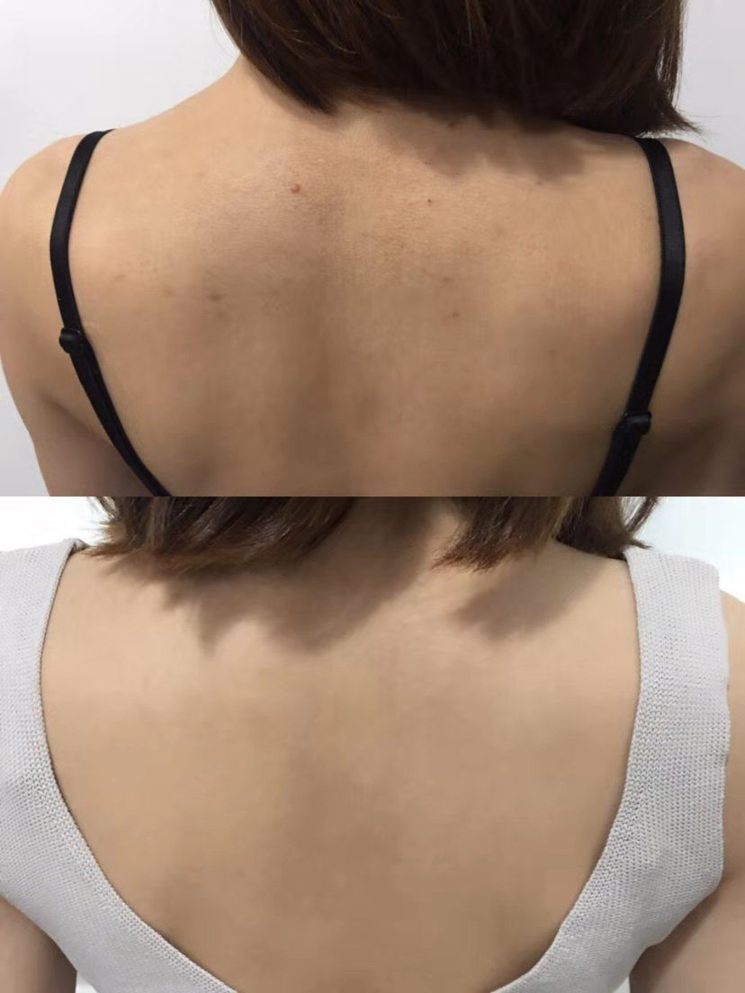 可美金箔祛痘螨虫皂,除螨皂能祛螨虫吗