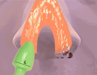 过敏性鼻窦炎怎么治用生理盐水,过敏性鼻炎鼻窦冲洗