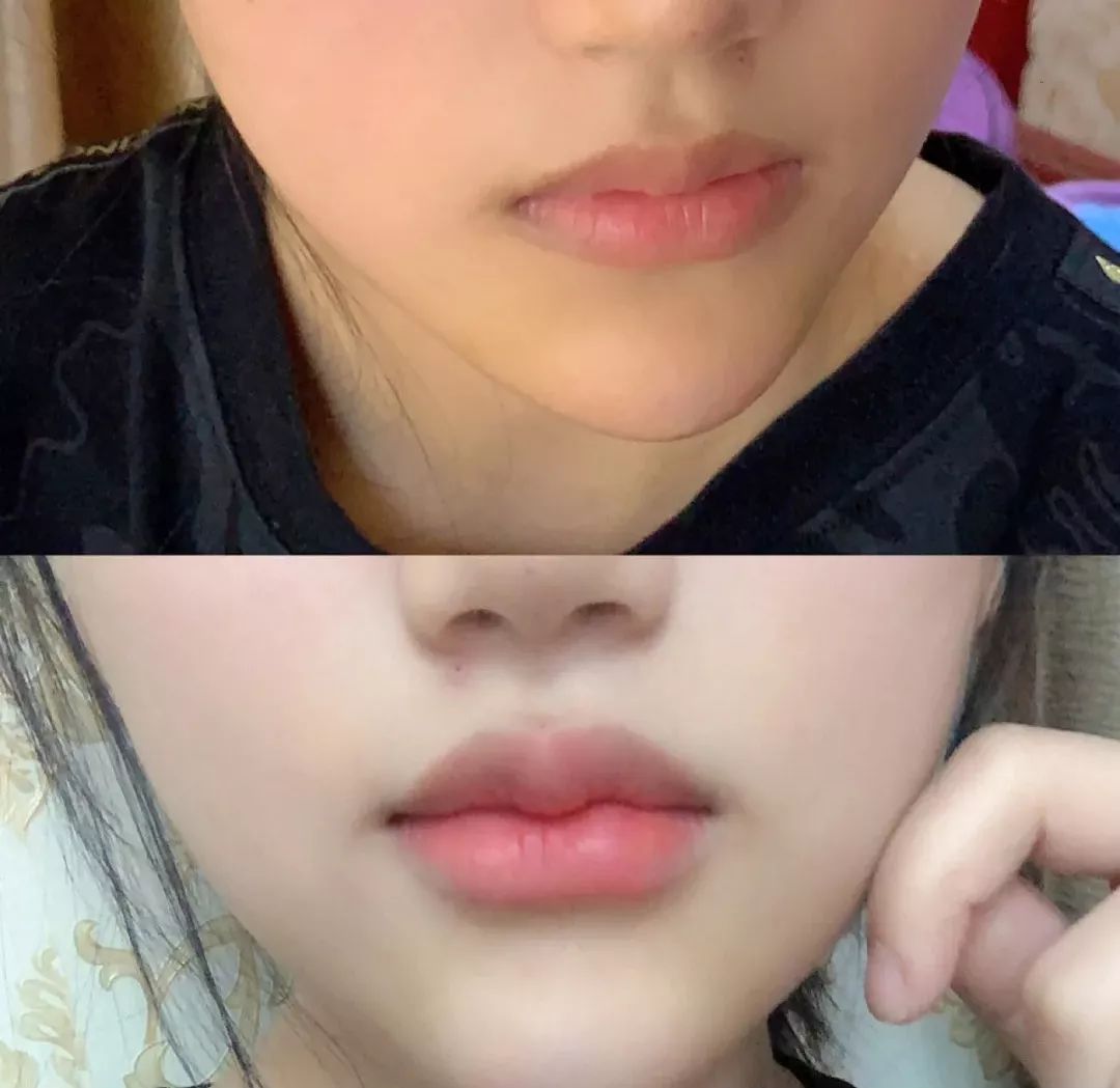 薄唇如何丰唇好看,丰唇使嘴唇变得更美