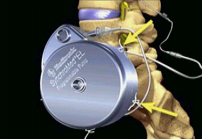 顽固性癌痛怎么止痛,用什么方法治疗癌性疼痛