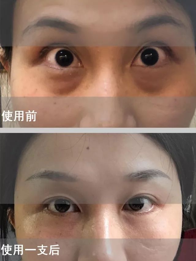 眼袋松弛下垂最快解决方法,严重眼袋下垂松弛怎么恢复