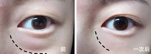 眼袋松弛下垂最快解决方法,严重眼袋下垂松弛怎么恢复