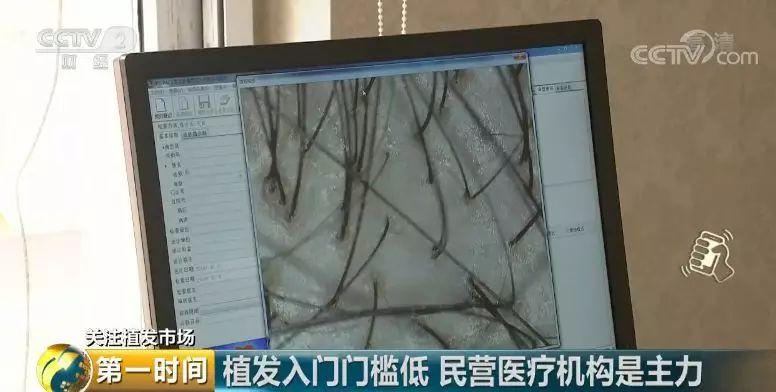 头顶脱发植发有用吗,中国脱发人数2024