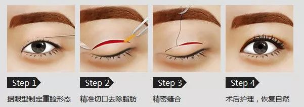 关于医美的真相大全,两年医美的真实感受