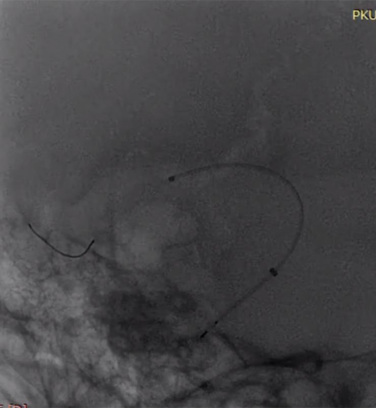 物华天宝·第7期｜脑部长型巨大夹层动脉瘤的4个密网支架桥接治疗复查治愈（附复查CTA结果）