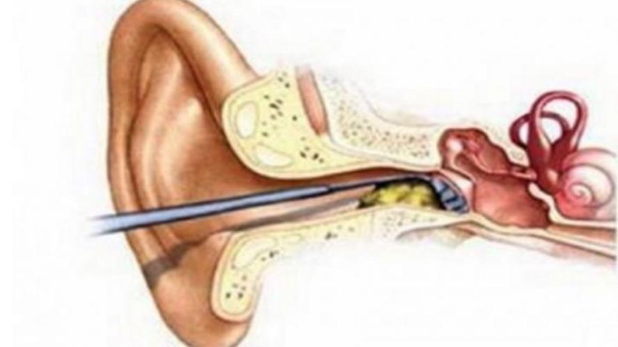 耳道小知识,关于耳屎你必须知道的几件事