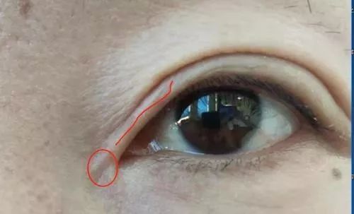 女子整容失败后欲哭无泪,女子整容整到脸上神经错乱