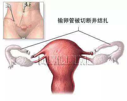 避孕药具基本知识内容,免费领取的避孕药具好用吗