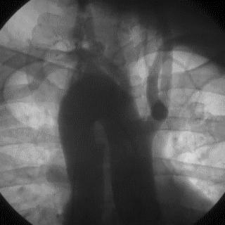 冠脉造影技术成熟不,跟我学技术分析从入门到精通