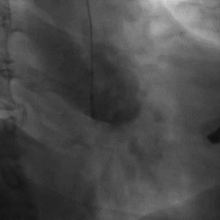 冠脉造影技术成熟不,跟我学技术分析从入门到精通