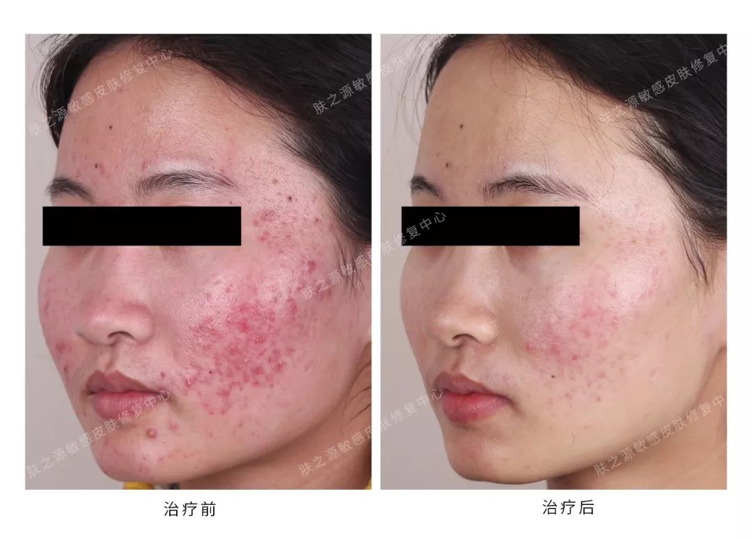 异维a酸是抗痘神器吗,异维a酸软胶囊祛痘坑痘疤