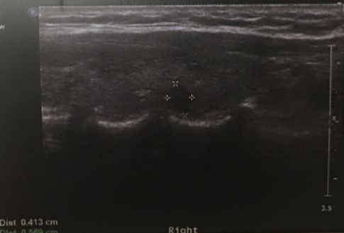 甲状腺微小癌如何确诊,甲状腺微小乳头状癌能治好吗