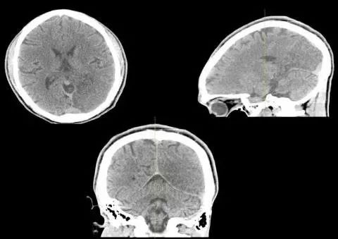 平山病、MELAS、MVNT、ODS丨3分钟读片·第15期