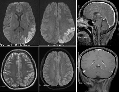 平山病、MELAS、MVNT、ODS丨3分钟读片·第15期