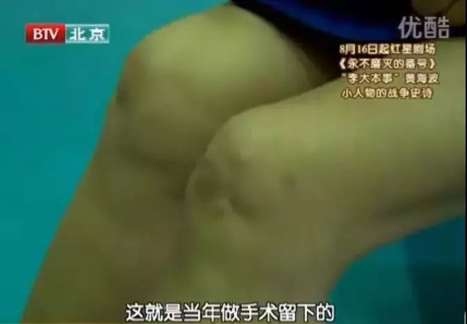 手指断了必须在关节处截掉吗,手指断了切掉还是接回来好点