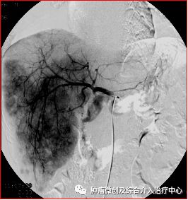 运城市第一医院介入科特色技术——肿瘤的化疗栓塞术