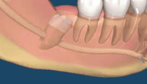 拔智齿的全过程科普,拔智齿细致操作过程