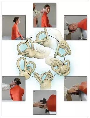 耳石症复位疗法视频,耳石症复位后的十大注意事项