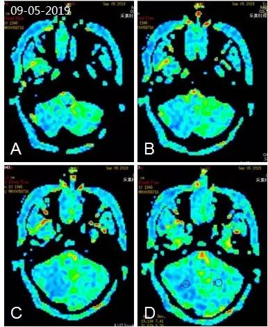 天坛周记·第147期｜右椎动脉V3-4段闭塞血管内介入治疗开通失败1例