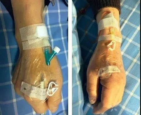 留置针u型敷贴正确撕法,留置针正确固定图片ppt