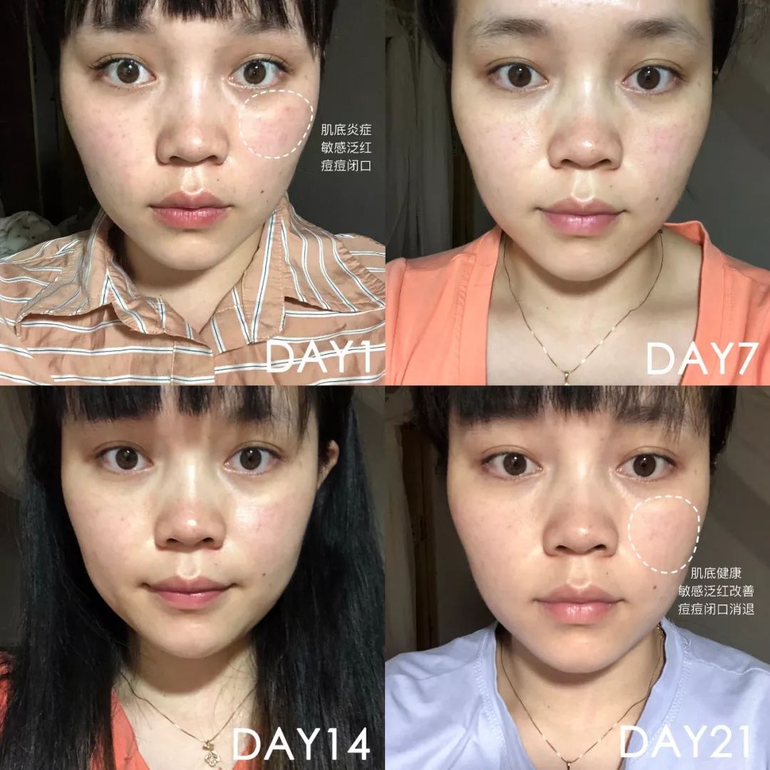 肌诊室·特别版|真人体验，医美素颜光vs明星微精华，改善皮肤哪家强？