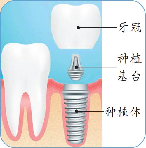 为什么口腔种牙那么贵,种牙是牙齿贵还是牙体贵