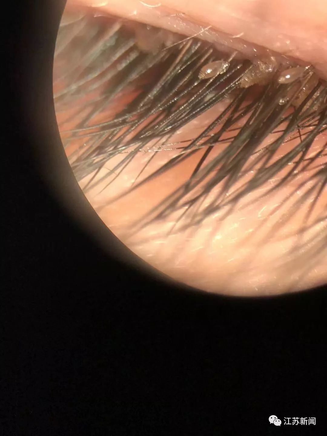 5岁女孩眼睛有虱子,宝宝一直揉眼睛是长虱子吗